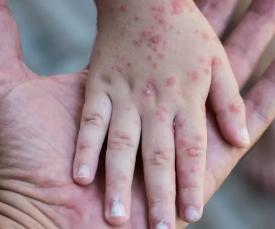 La rougeole réapparaît au Tagant : un mort et des dizaines de cas 